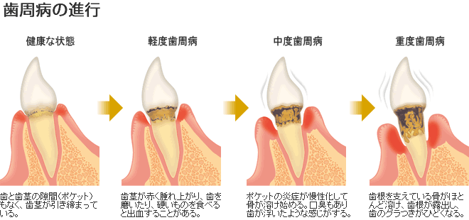 歯周病の進行